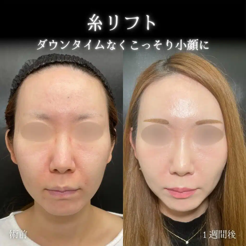 糸リフト