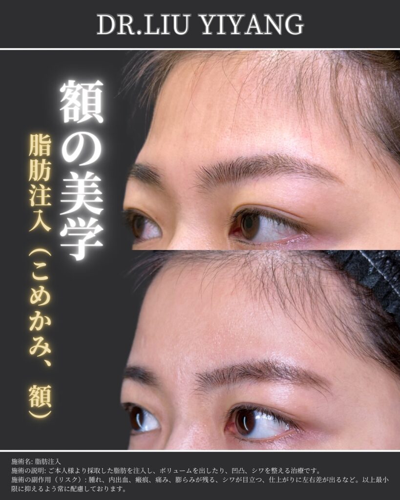こめかみと額の脂肪注入の症例写真 (1)