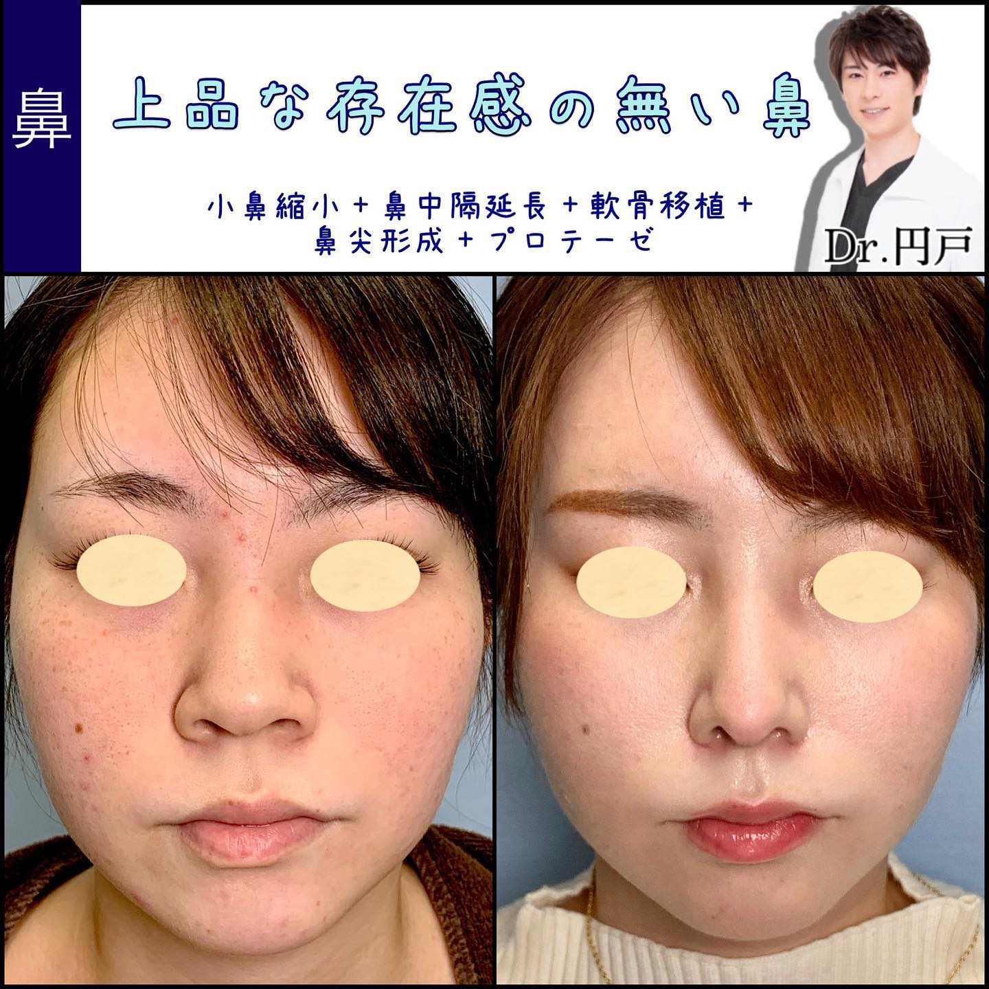 小鼻縮小と鼻中隔延長と軟骨移植と鼻尖形成と鼻のプロテーゼの症例写真 (2)