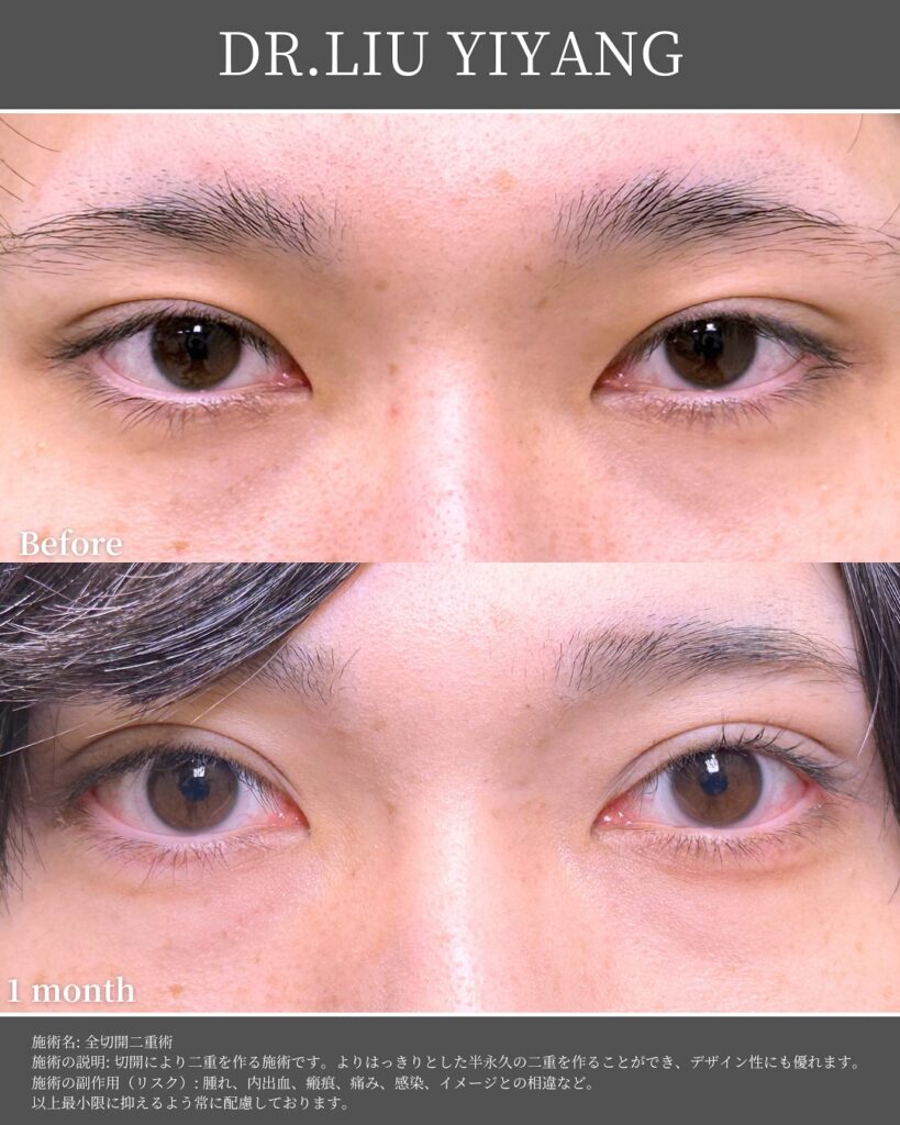 男性の全切開の症例写真
