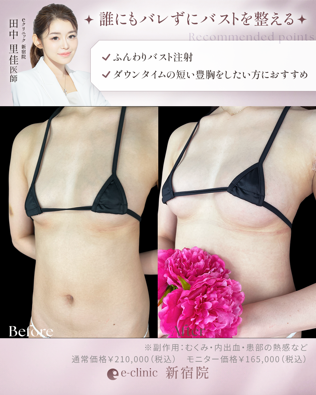 ふんわりバスト症例