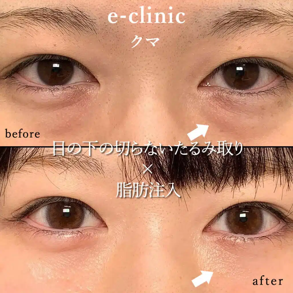 eclinic新宿院の表ハムラの症例（1）