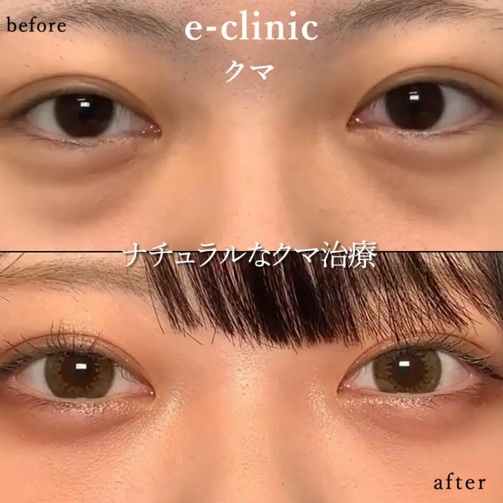 eclinic新宿院の表ハムラの症例（2）