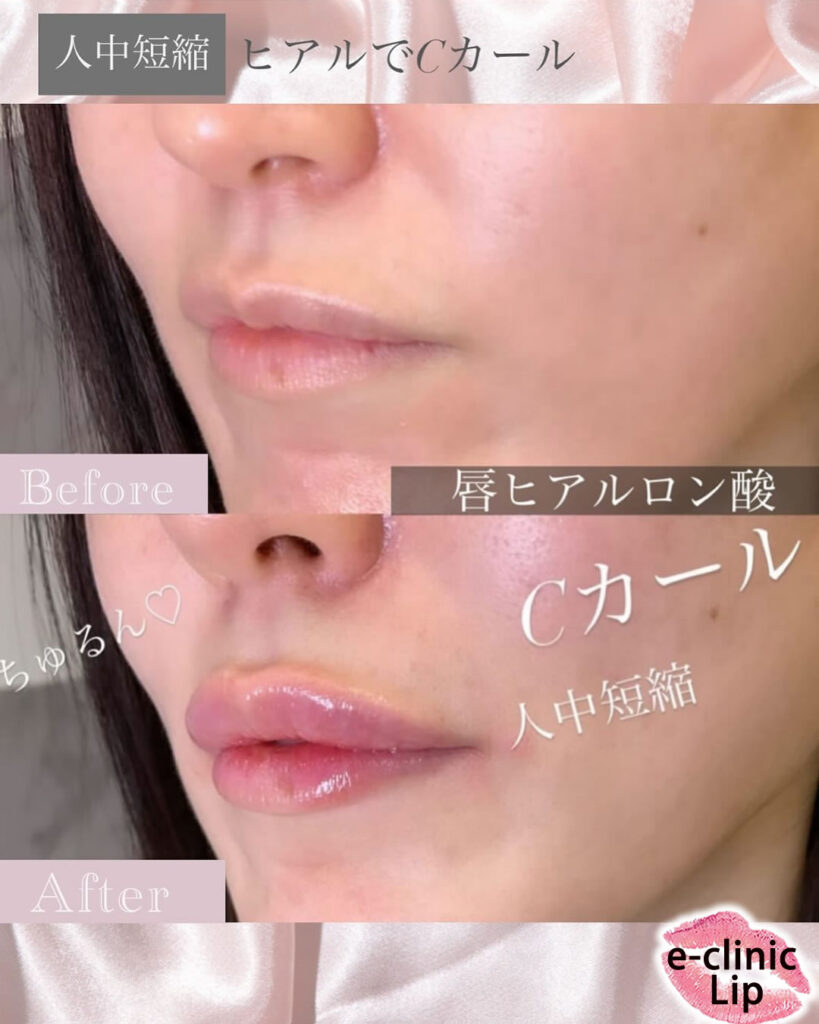 唇のヒアルロン酸の症例写真 (4)