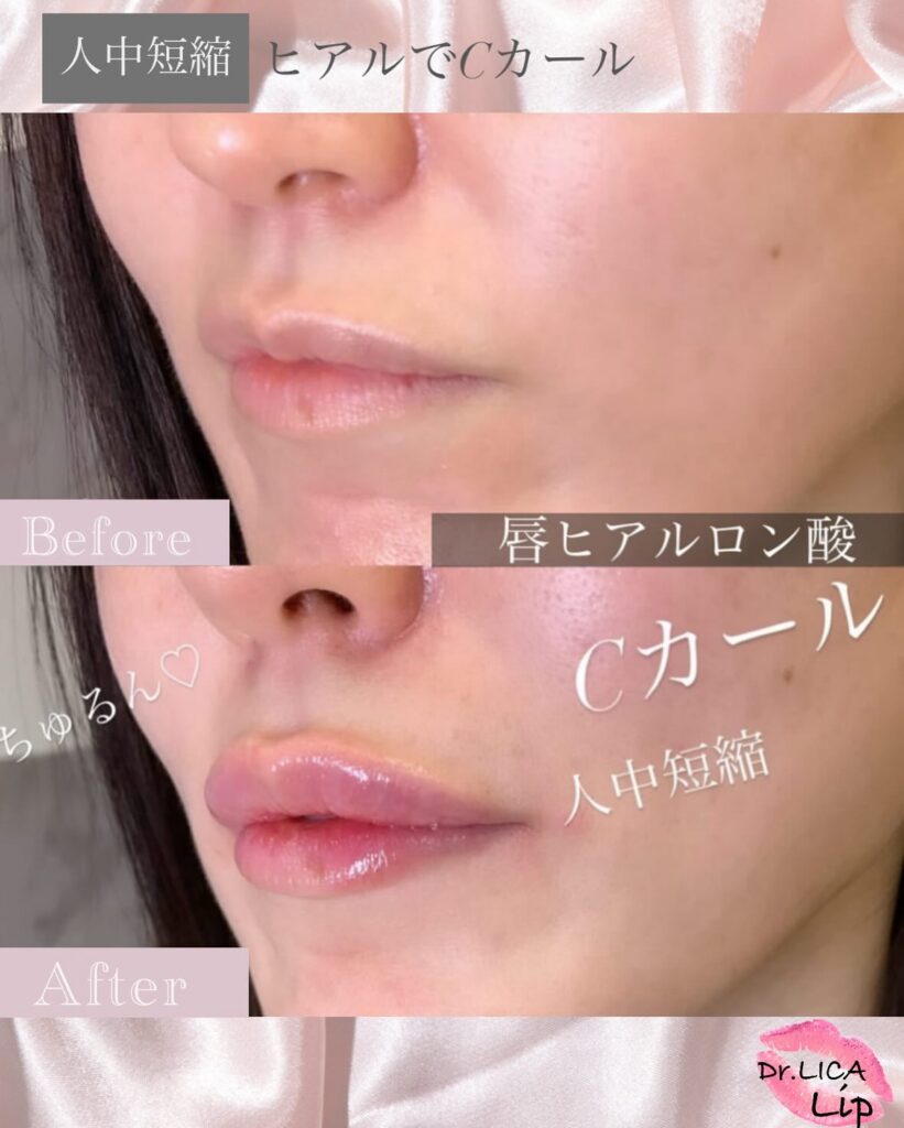 唇のヒアルロン酸の症例写真 (4)