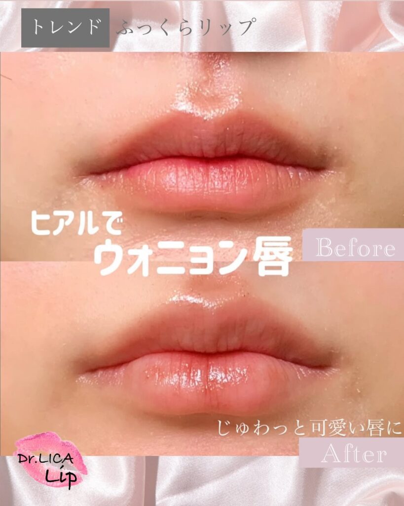 唇のヒアルロン酸の症例写真 (11)
