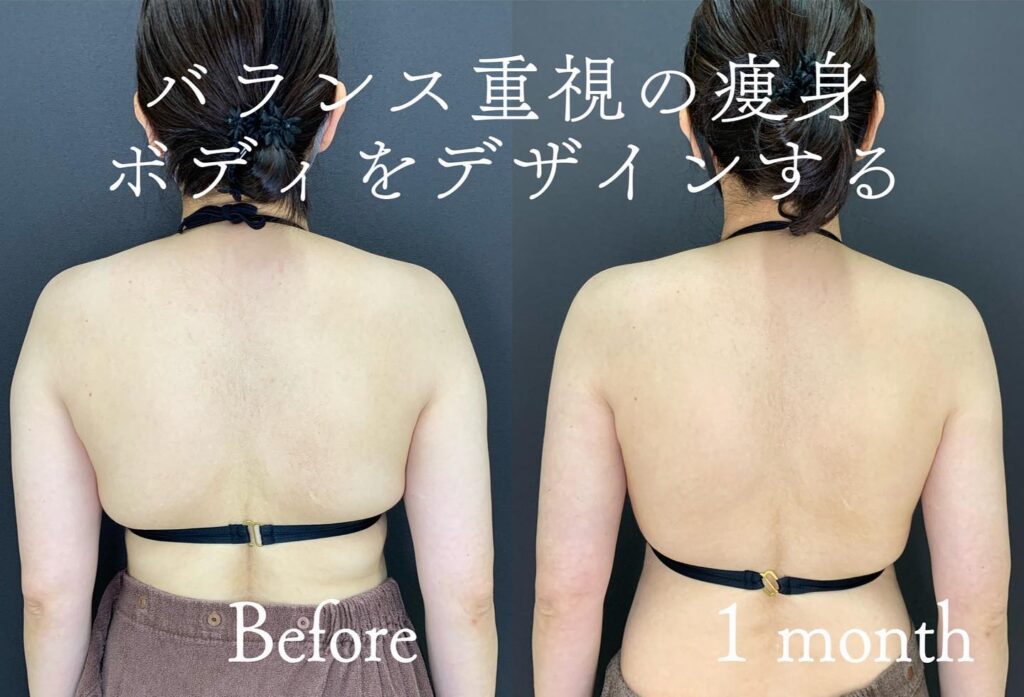 肩・背中・二の腕の脂肪吸引の症例写真 (9)