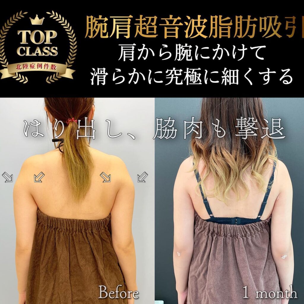 二の腕の脂肪吸引の症例写真 (3)