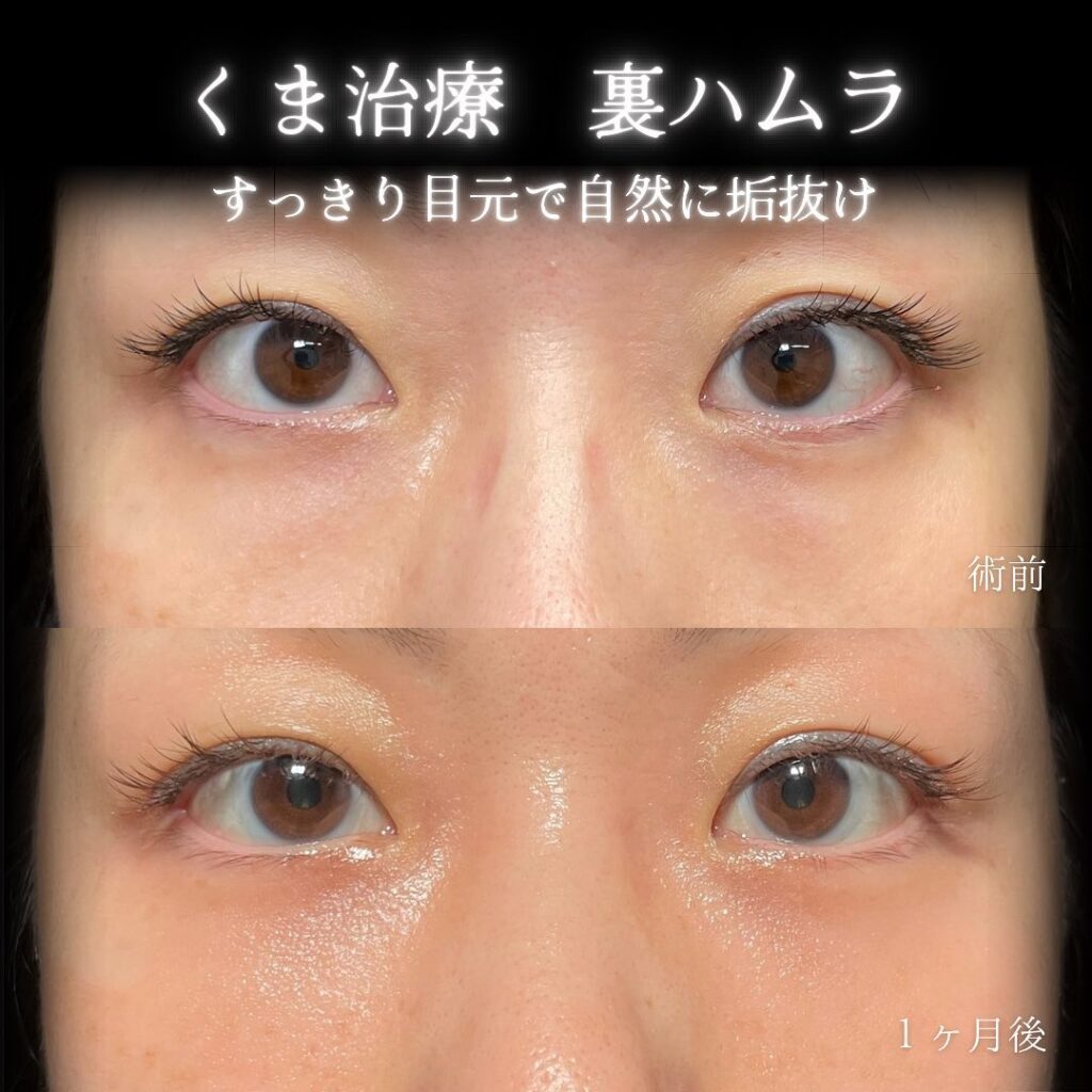 eclinic新宿院の表ハムラの症例（4）