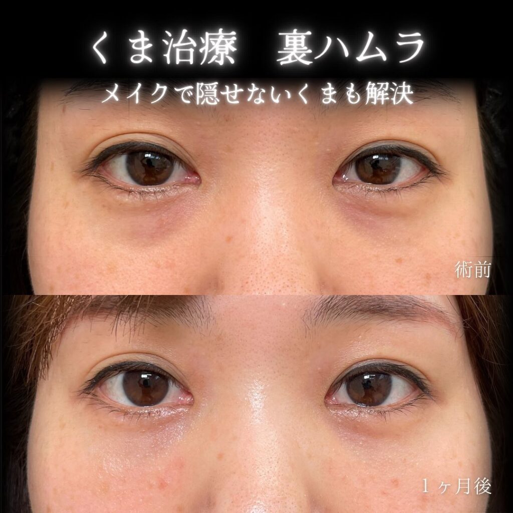 eclinic新宿院の表ハムラの症例（5）