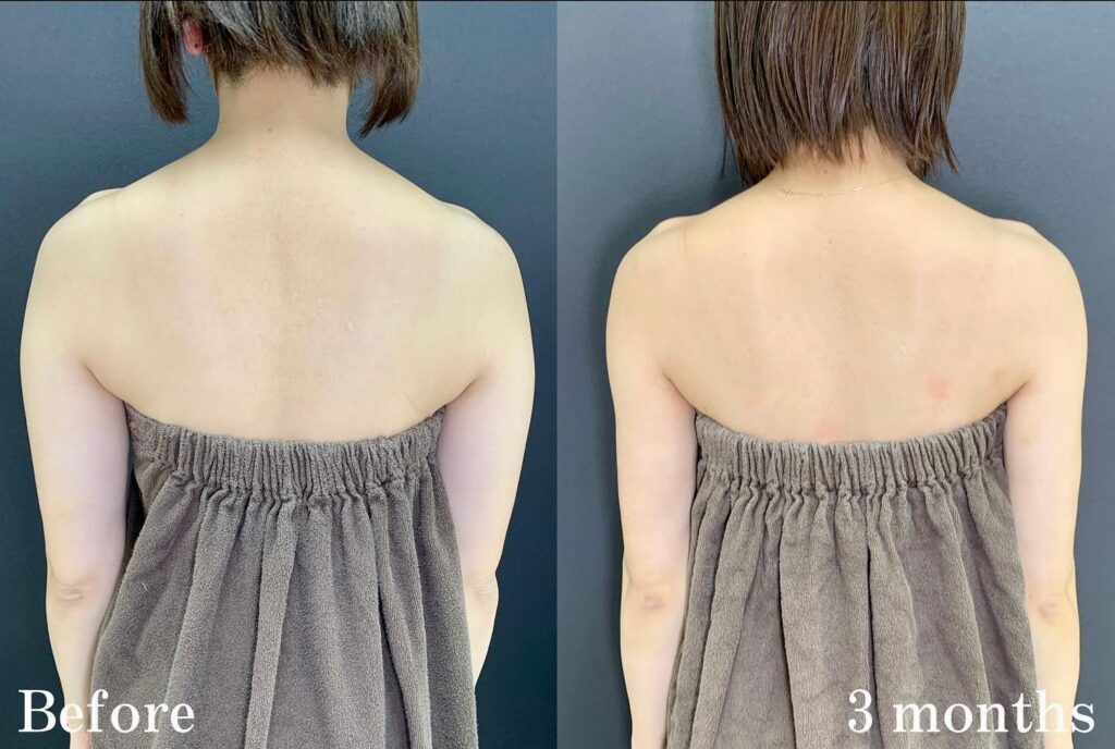腕肩の脂肪吸引の症例写真 (15)