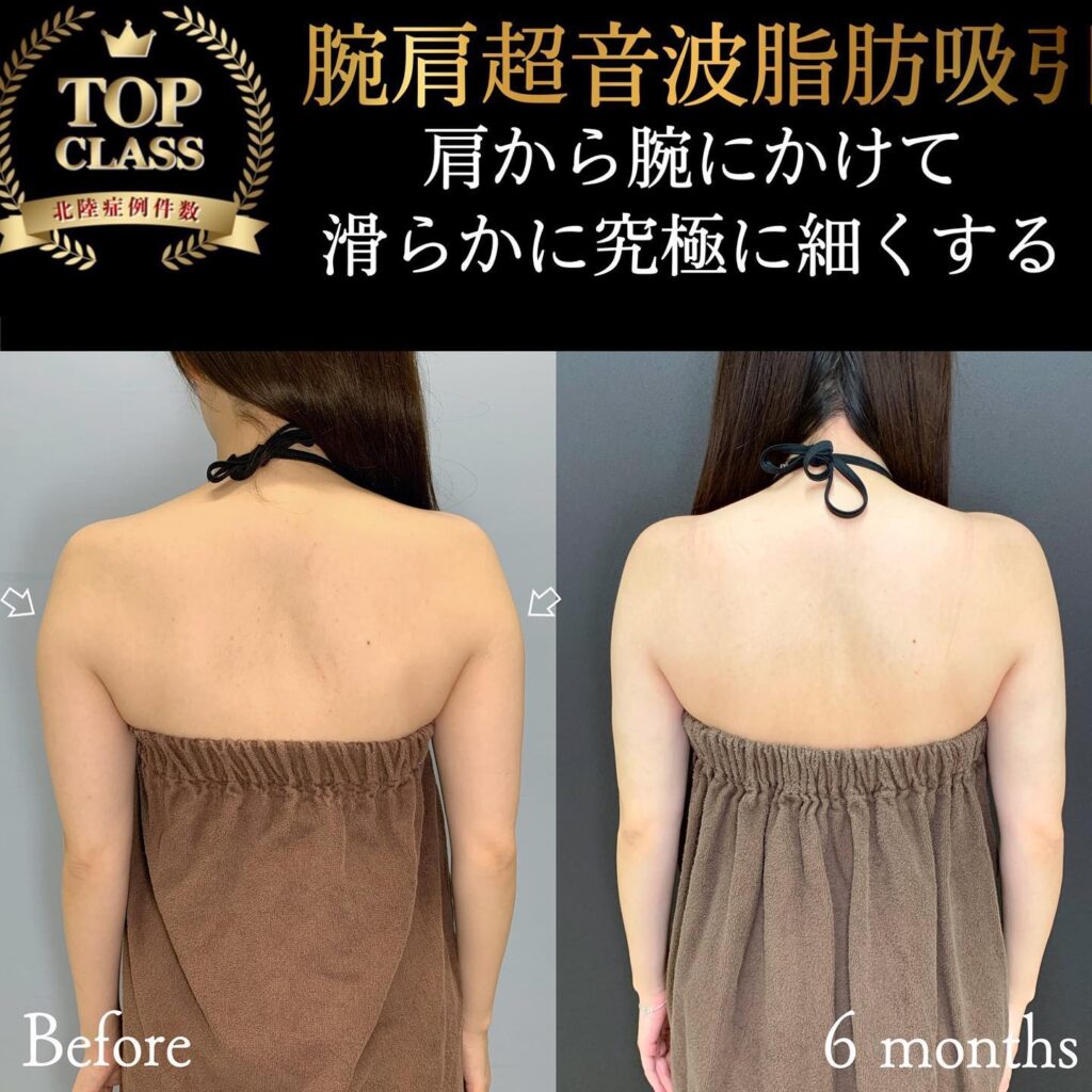 二の腕の脂肪吸引の症例写真 (12)