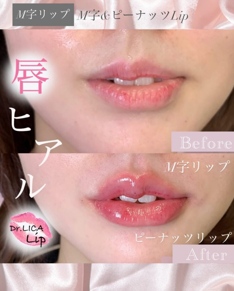 唇のヒアルロン酸の症例写真 (9)