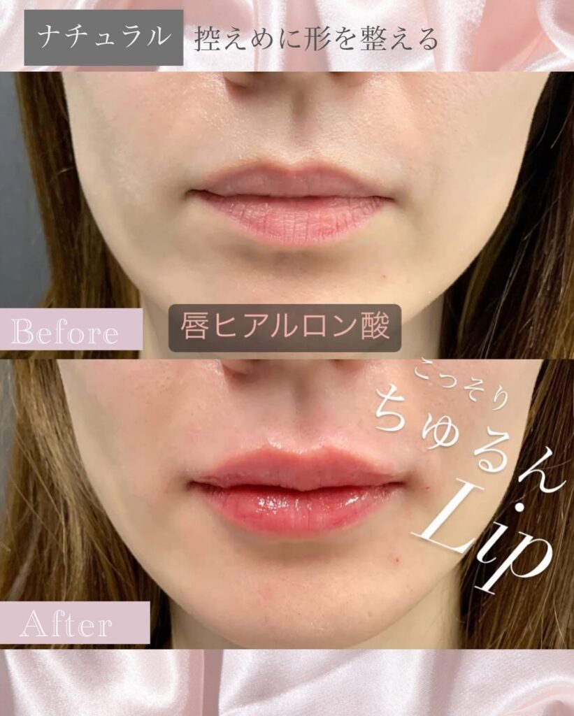 唇のヒアルロン酸の症例写真 (5)
