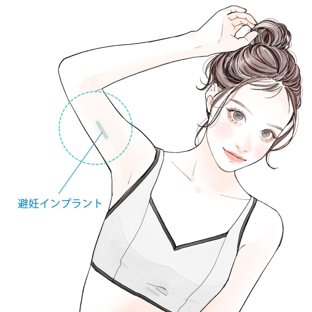 避妊インプラントを埋め込んでいるイメージ