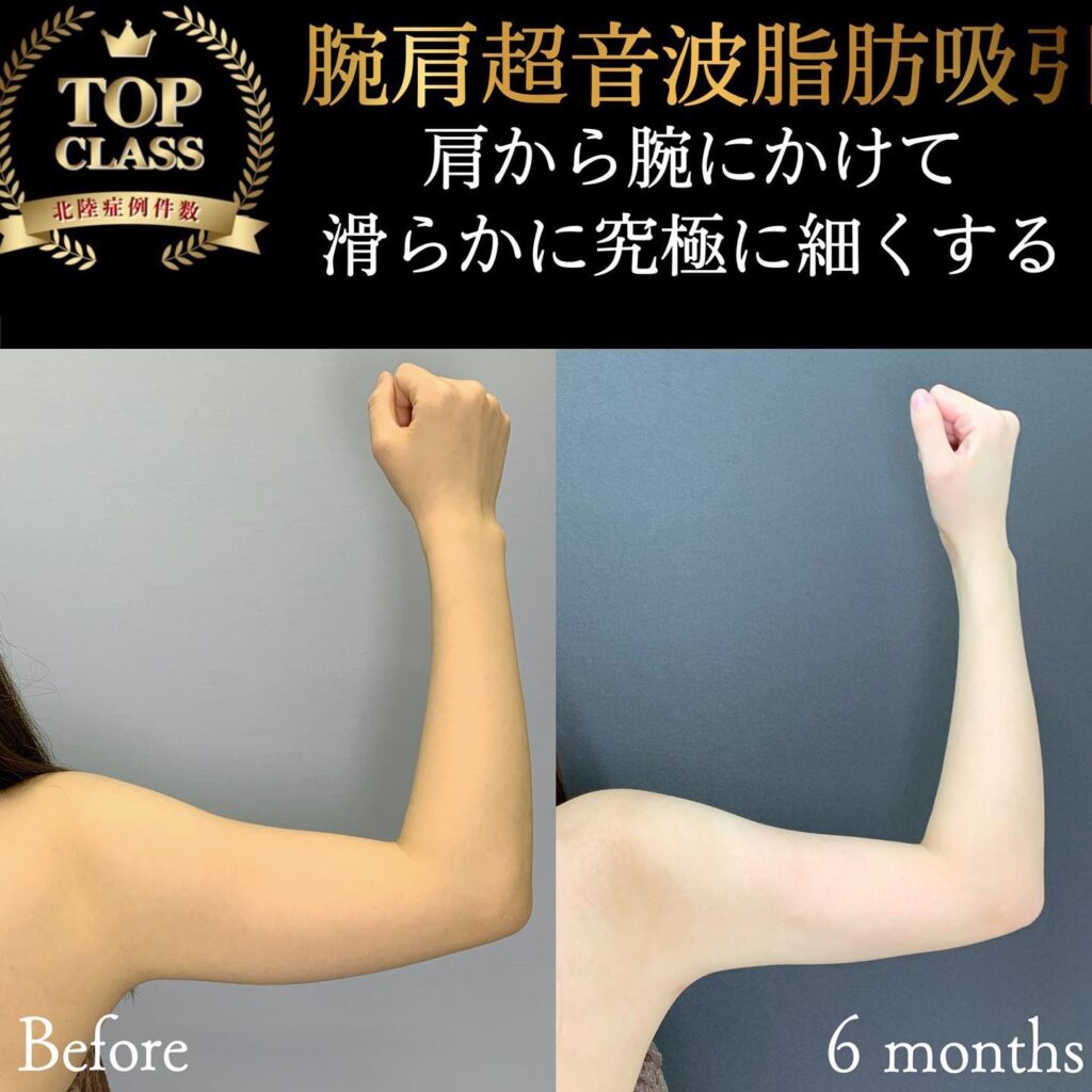 二の腕の脂肪吸引の症例写真 (10)