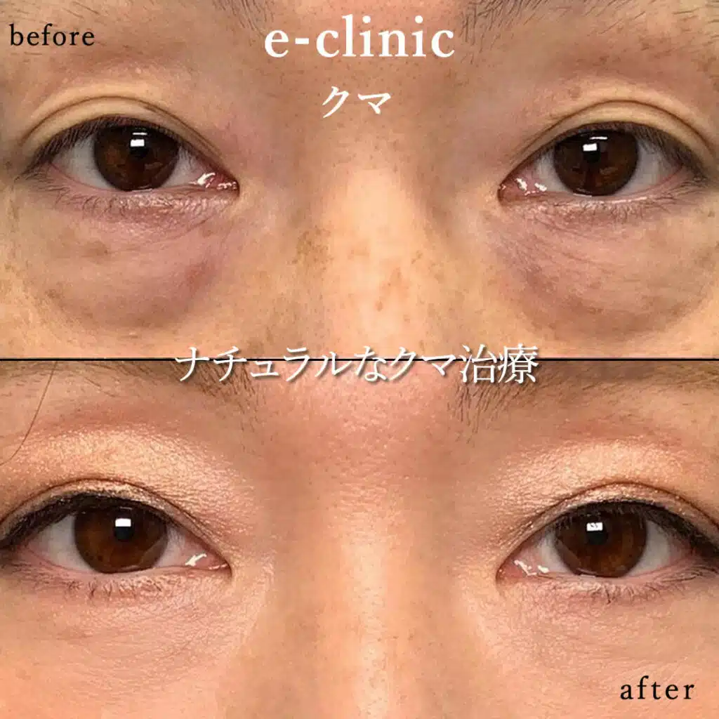 eclinic新宿院の表ハムラの症例（3）