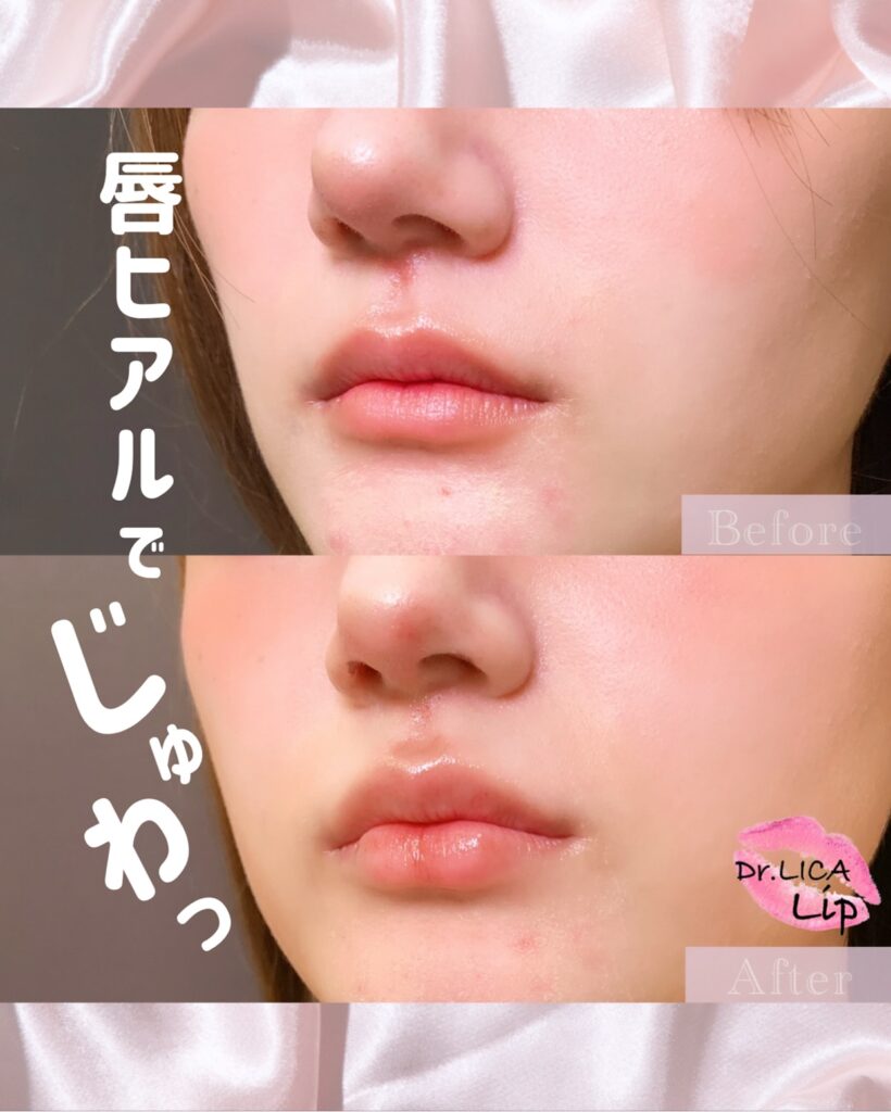唇のヒアルロン酸の症例写真 (3)