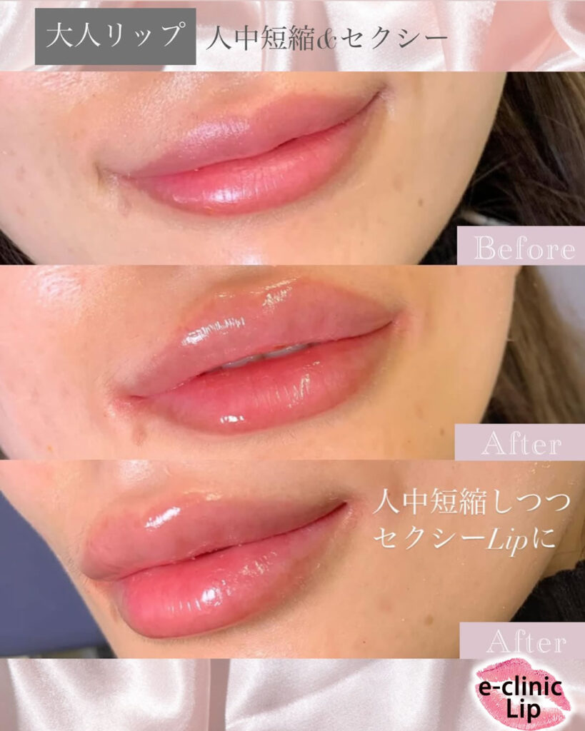 唇のヒアルロン酸の症例写真 (7)