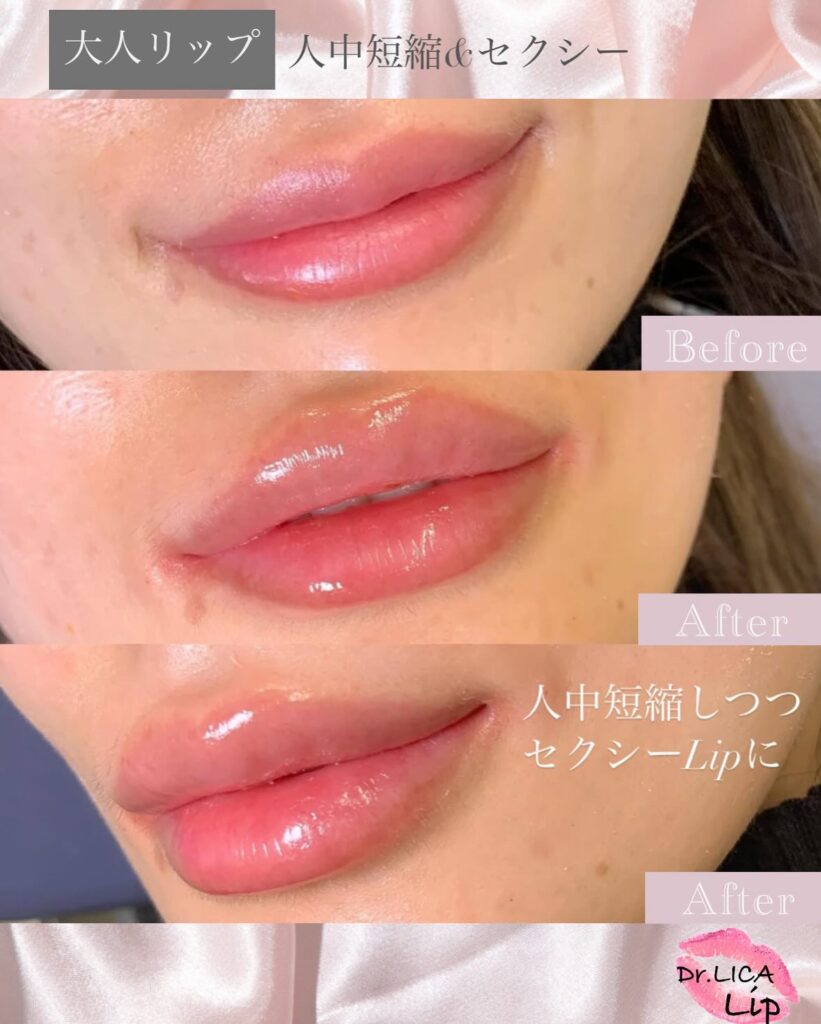 唇のヒアルロン酸の症例写真 (7)