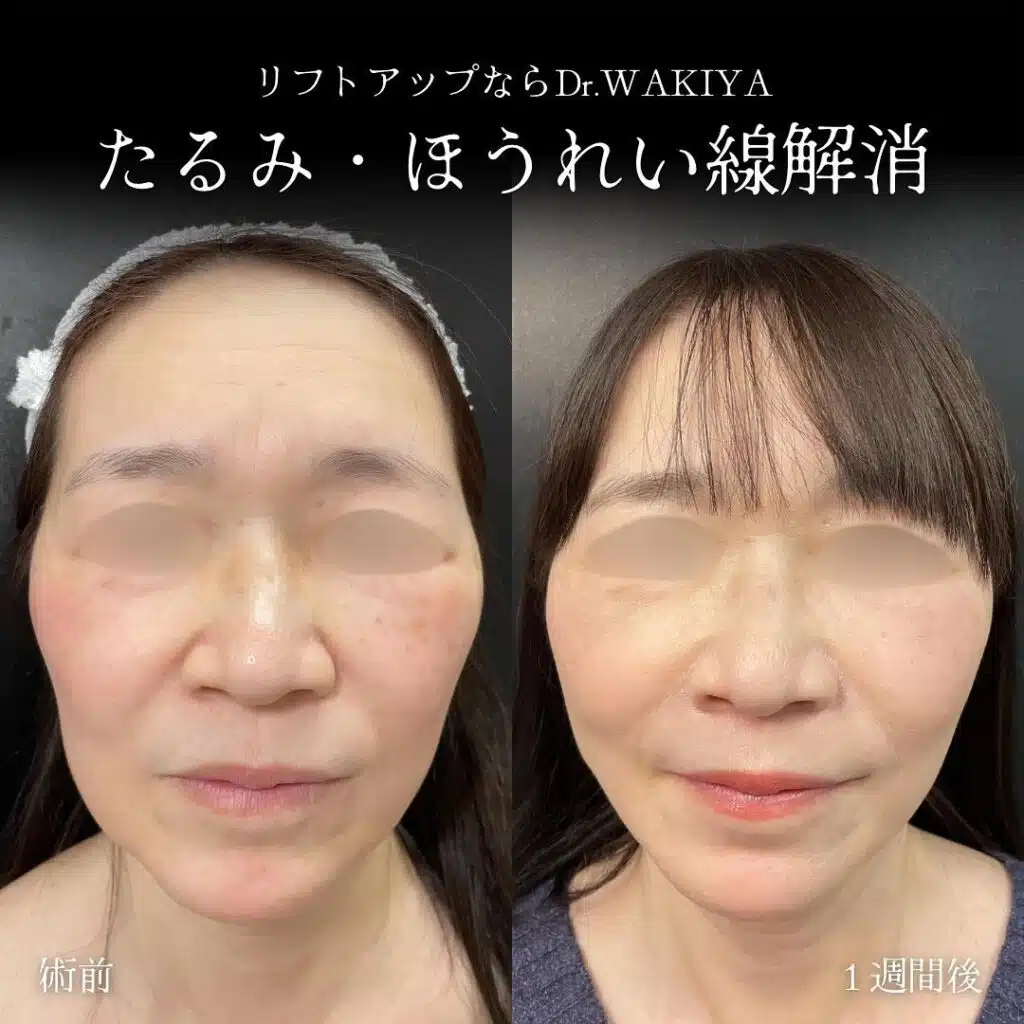 たるみ・ほうれい線解消　新宿　