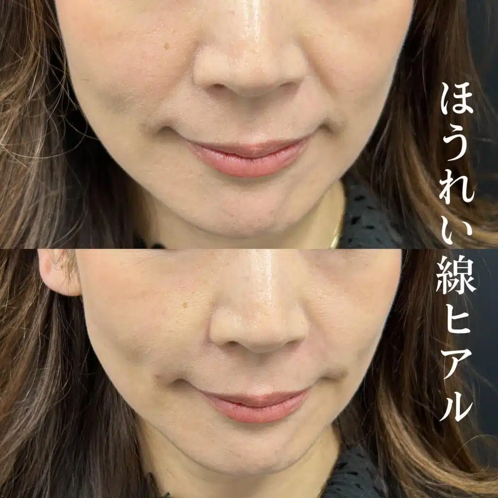 ほうれい線ヒアル　新宿