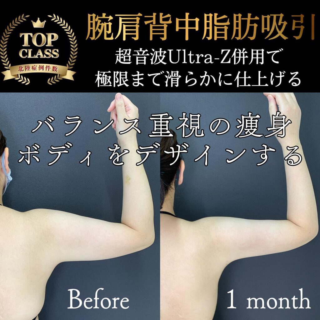 二の腕の脂肪吸引の症例写真 (7)