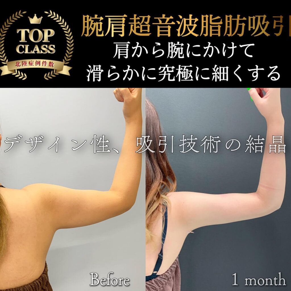 二の腕の脂肪吸引の症例写真 (2)