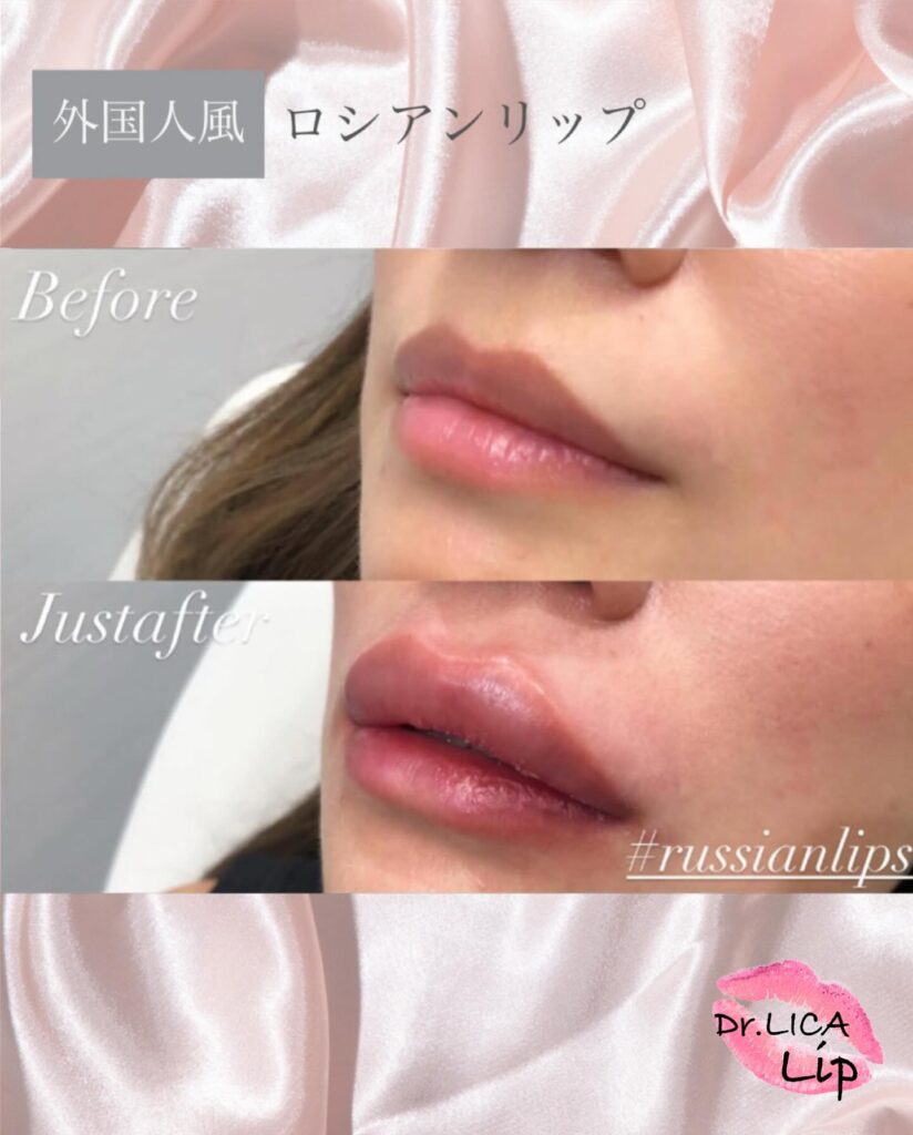 唇のヒアルロン酸の症例写真 (8)