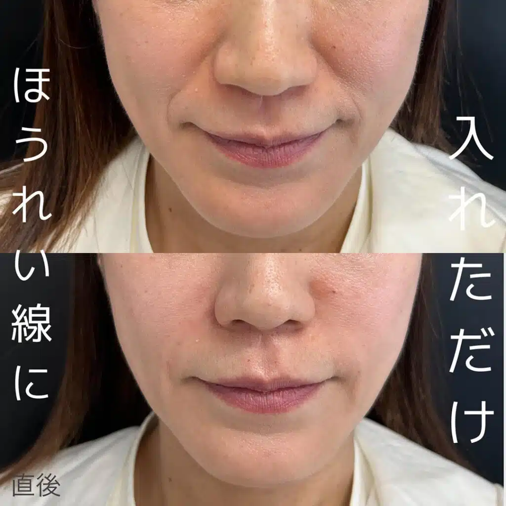 ほうれい線に入れただけ　新宿