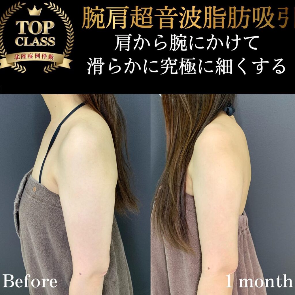 二の腕の脂肪吸引の症例写真 (13)