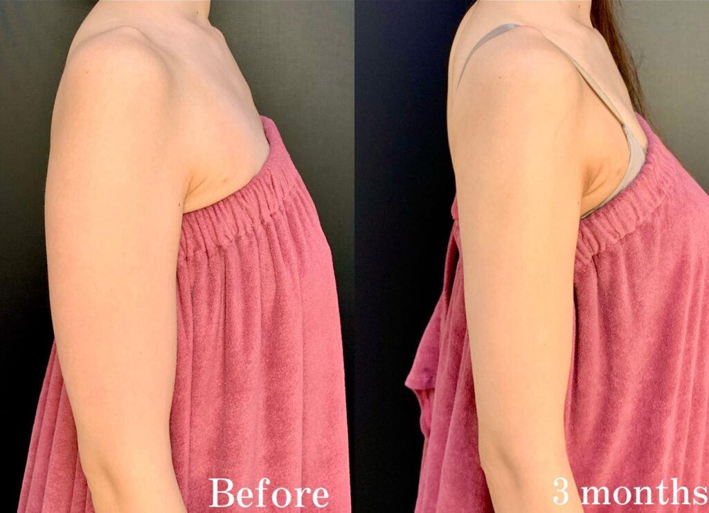 二の腕の脂肪吸引の症例写真 (1)