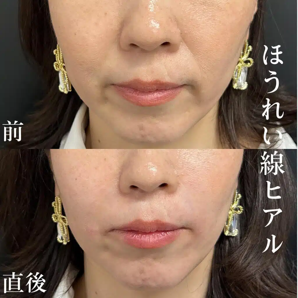 ほうれい線ヒアル　新宿