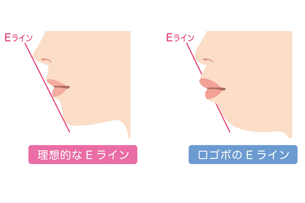 口ゴボと理想的なEラインの解説