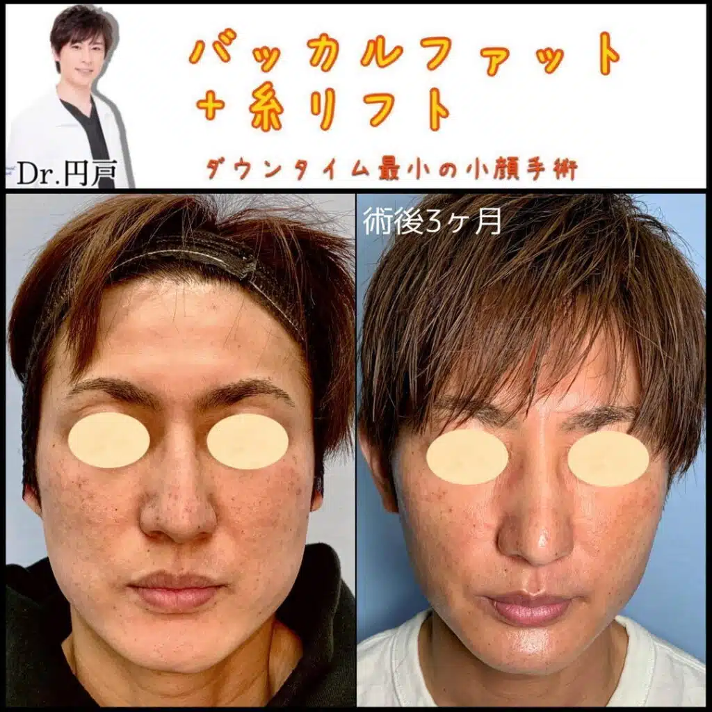 バッカルファット＋糸リフト　新宿