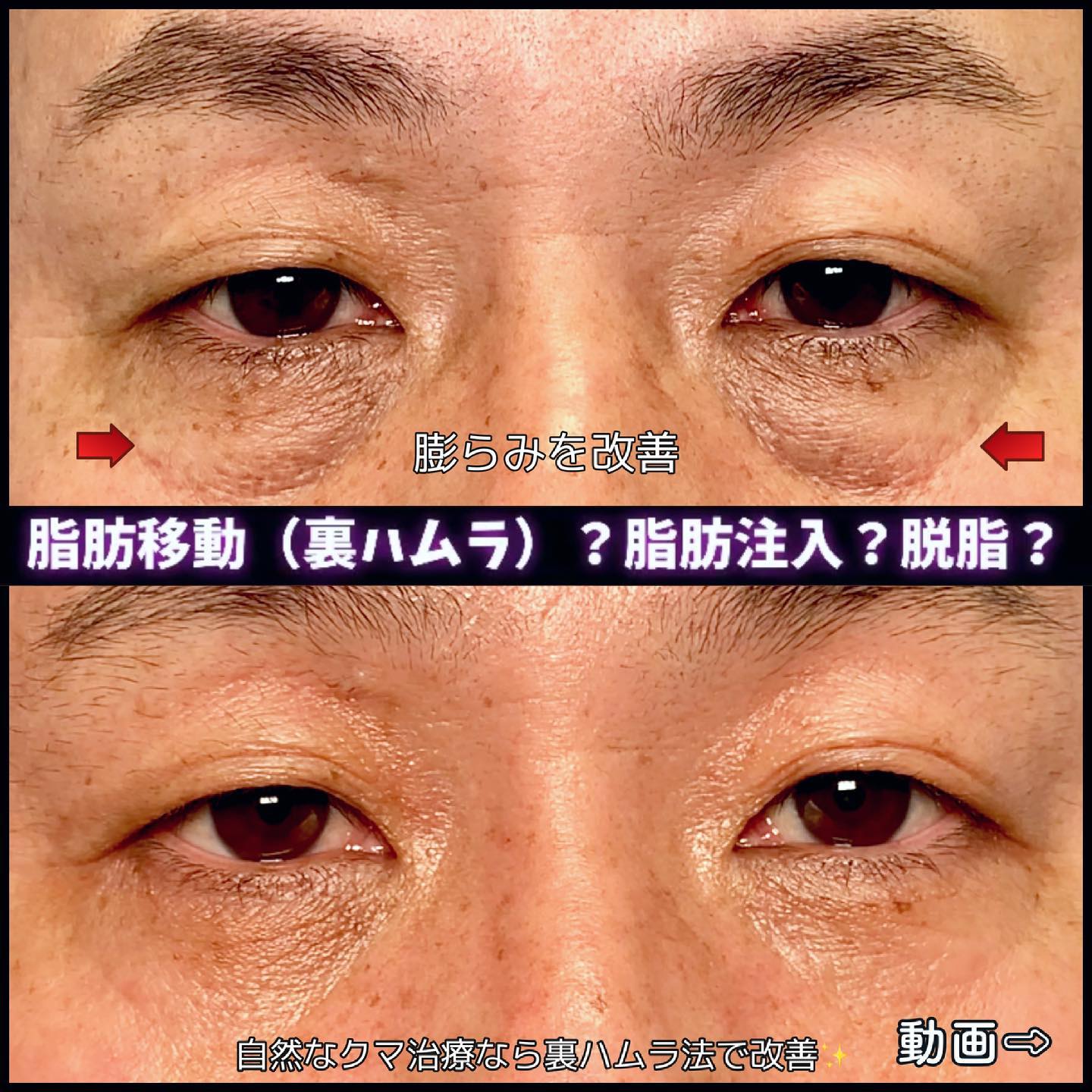 裏ハムラと脂肪注入