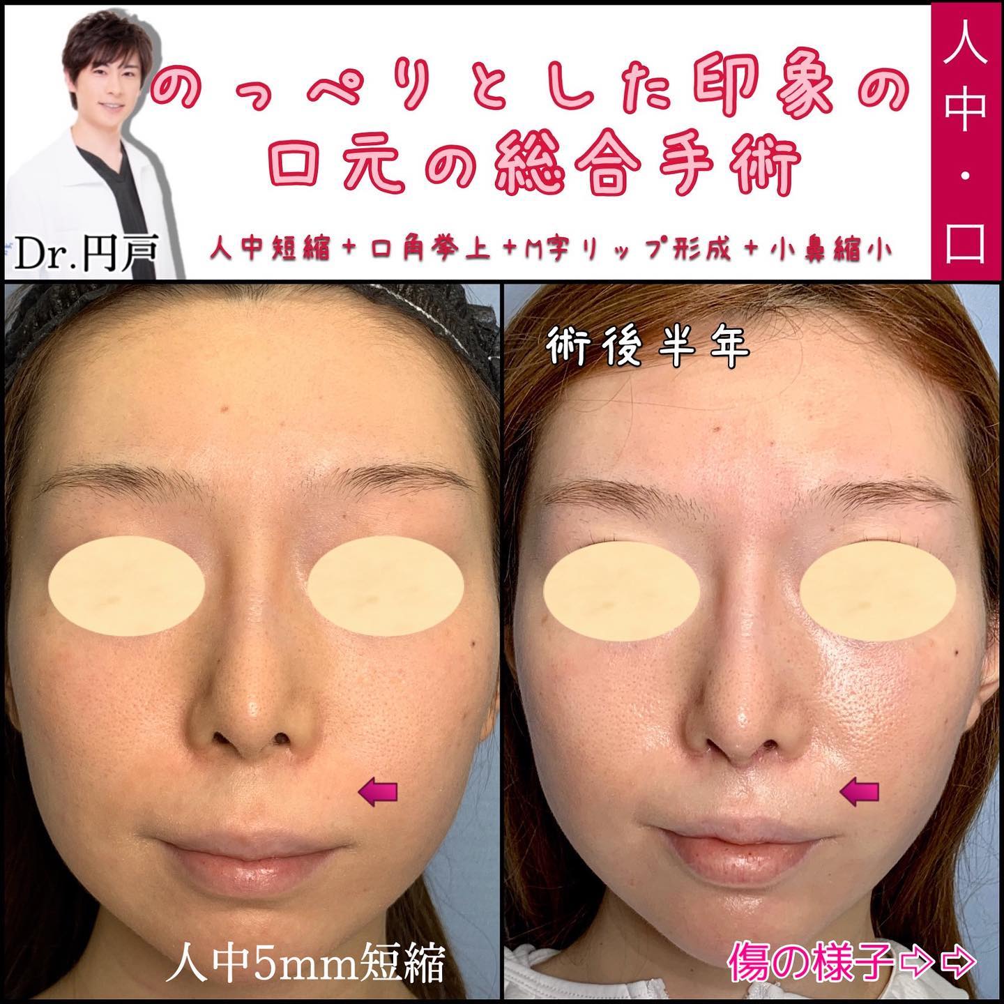 人中短縮と口角挙上とM字リップと小鼻縮小の症例写真