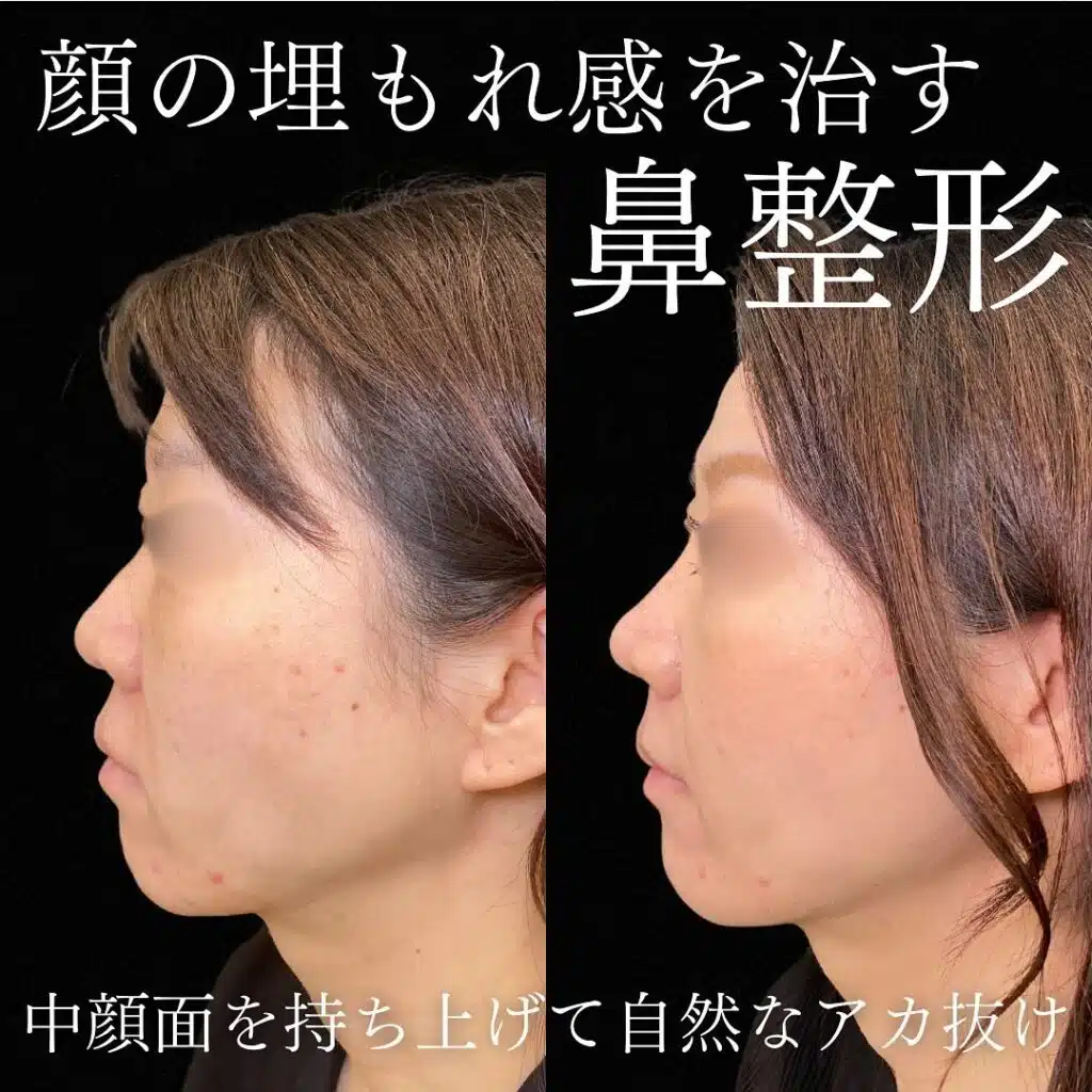 鼻尖形成クローズ法と耳軟骨移植と鼻プロテーゼと小鼻縮小と猫貴族と人工真皮と人中短縮術と糸リフトの症例写真 新宿