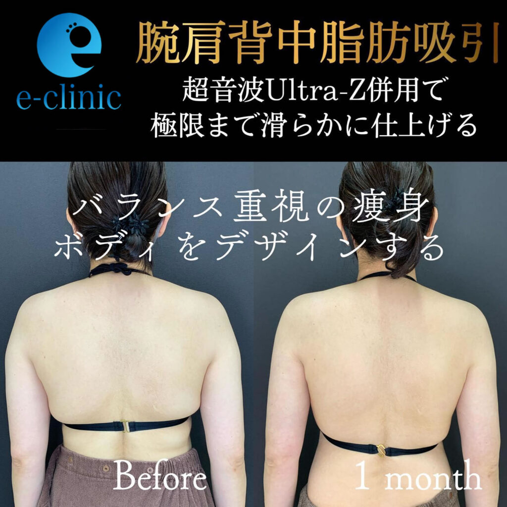 腕肩の脂肪吸引