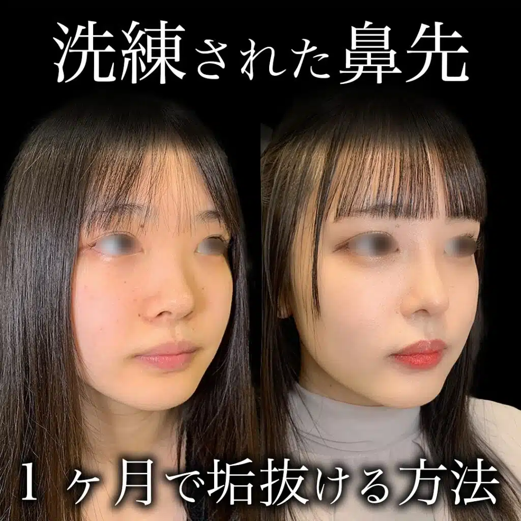 隆鼻術(鼻プロテーゼ) 新宿
