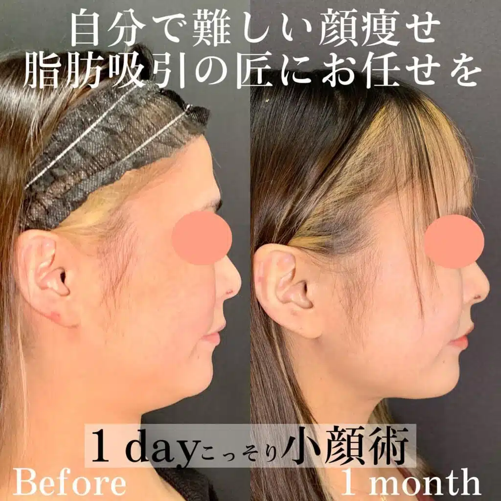小顔脂肪吸引　新宿