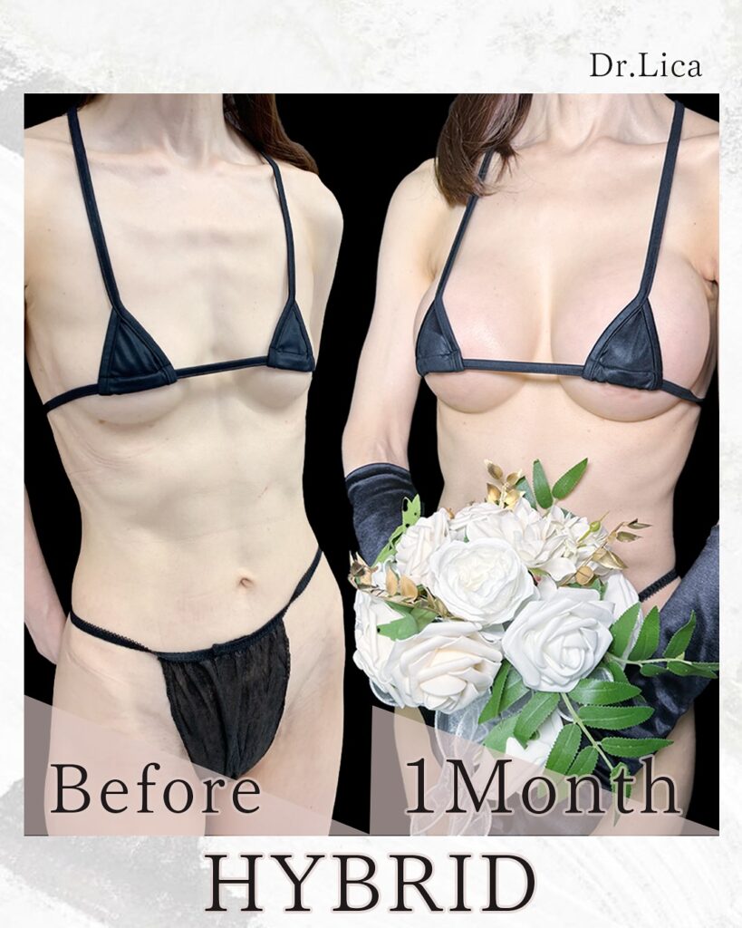 豊胸手術の名医の田中里佳医師が行ったハイブリッド豊胸の症例写真