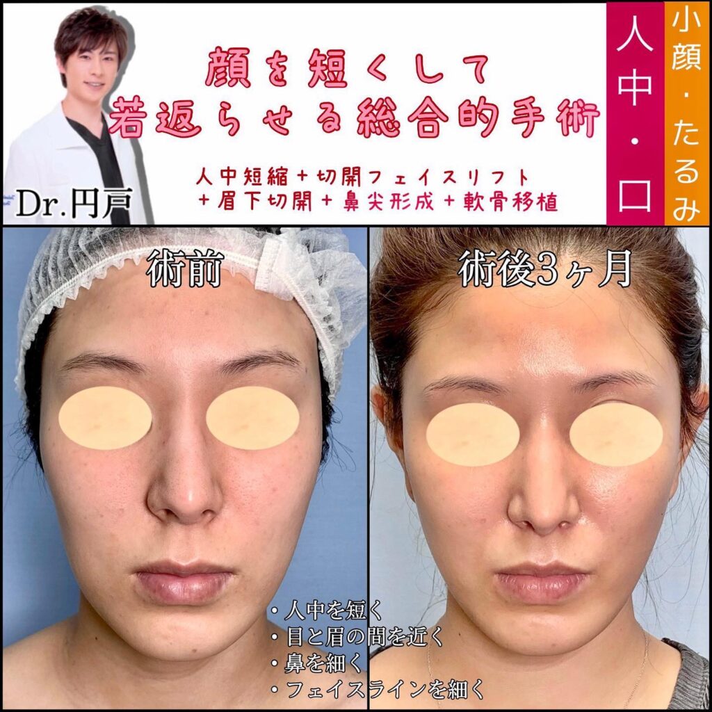 脂肪吸引と糸リフトと切開リフトの症例写真