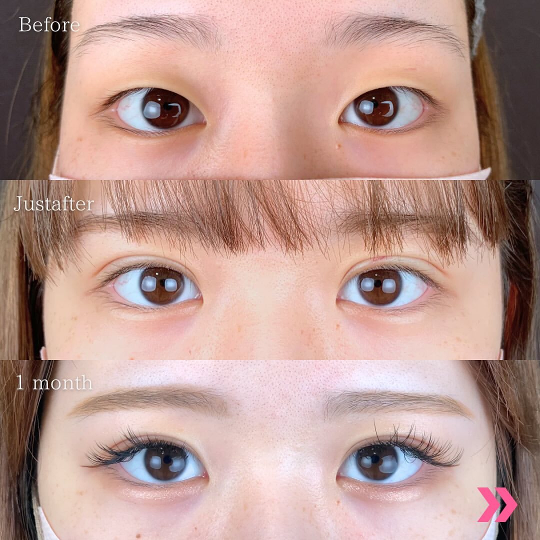 自然癒着法を受けた女性の諸例写真 (4)