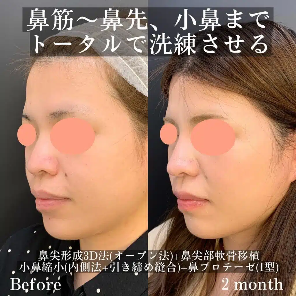 鼻尖形成3D法(オープン法)+鼻尖部軟骨移植+小鼻縮小(内側法+引き締め縫合)+鼻プロテーゼ(Ⅰ型) 新宿