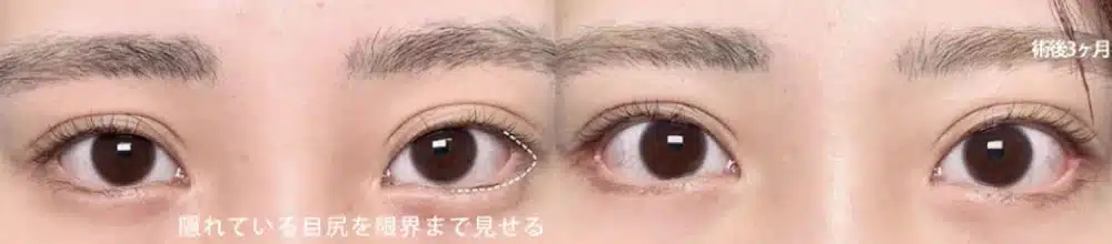 目尻側の白目の露出を増やすデザイン 新宿