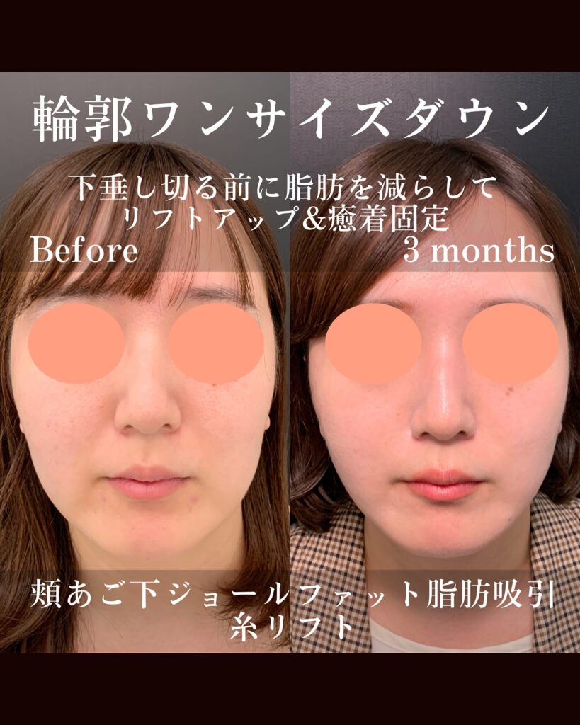 ジョールファットと糸リフトの症例写真 (4)
