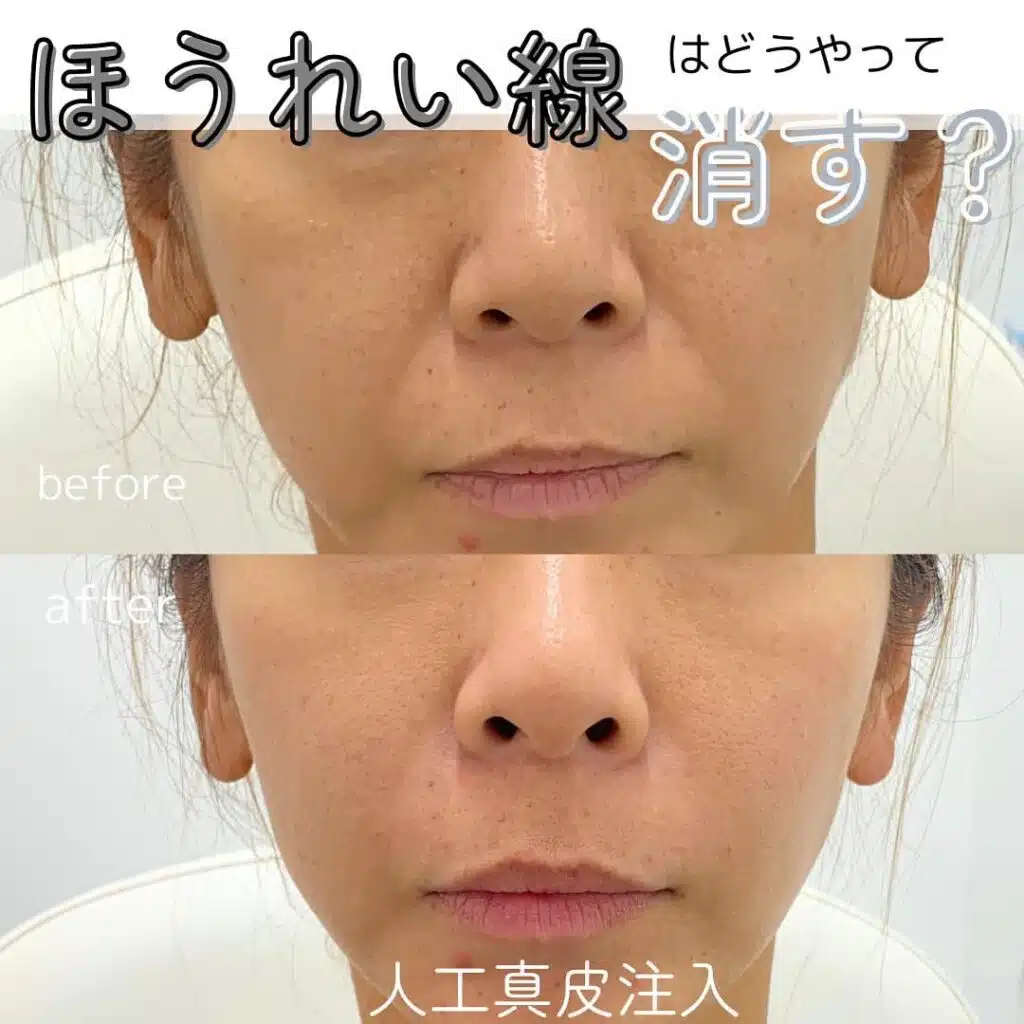人工真皮注入　新宿