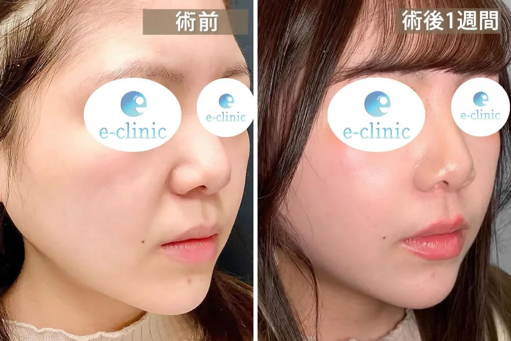 貴族手術の１週間後の症例写真