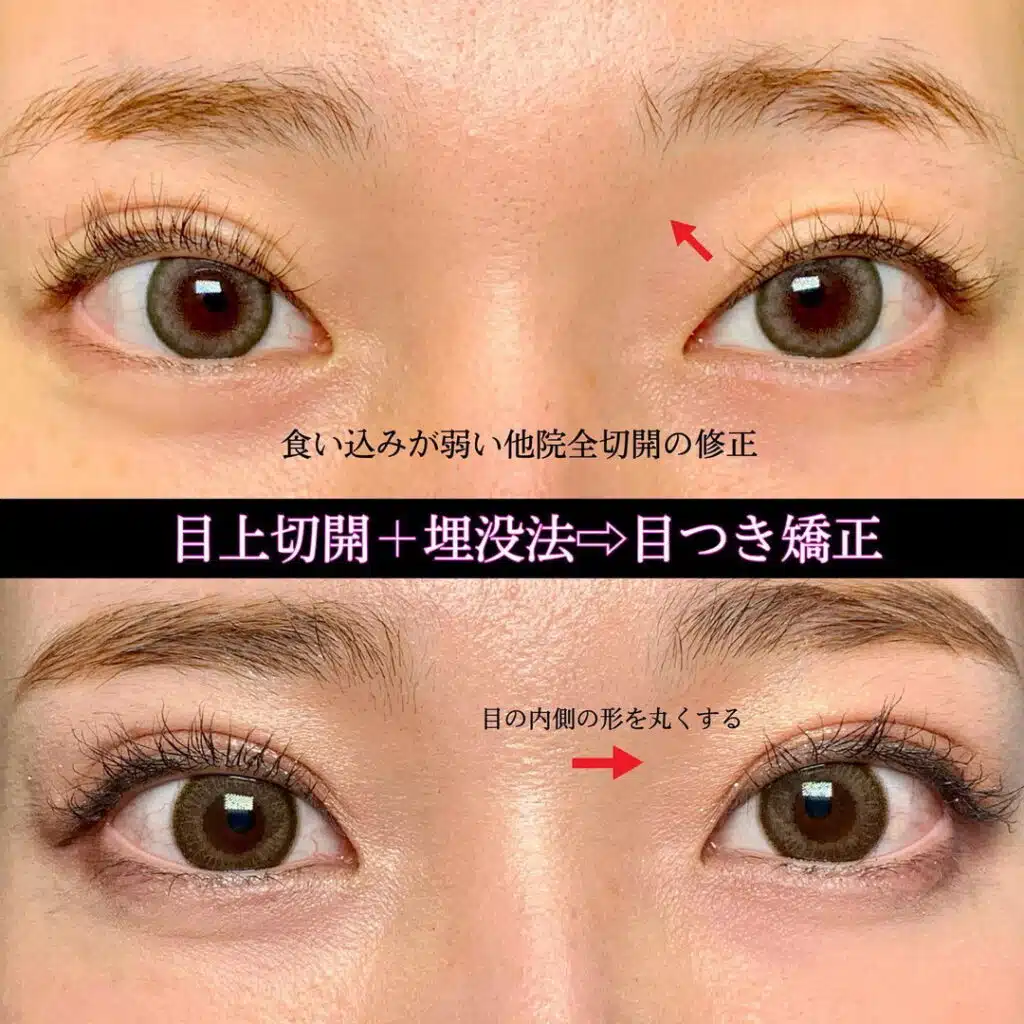 目上切開+埋没法　新宿